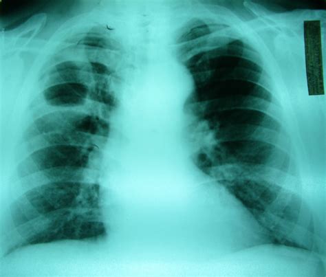 Абсцесс легкого рентген