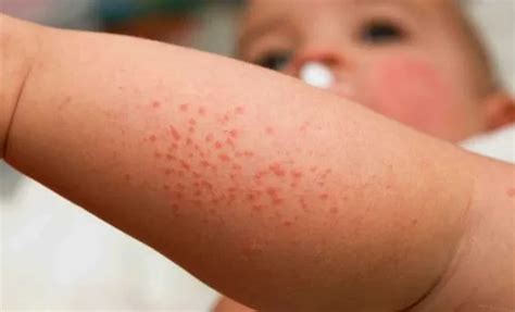 Аллергическая сыпь у ребенка