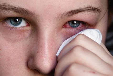 Аллергия на слезы