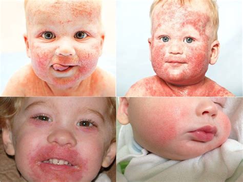 Аллергия на солнце у детей
