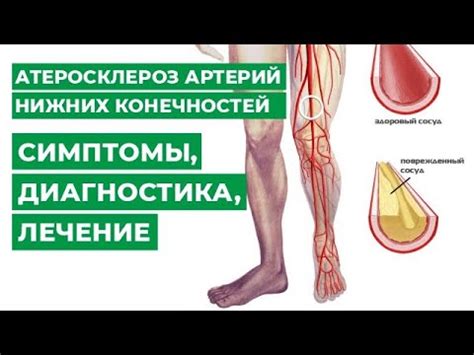 Атеросклероз нижних конечностей лечение препараты симптомы и лечение