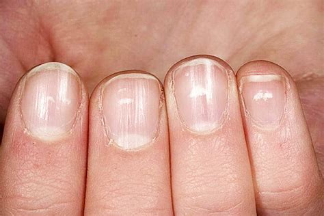 Белые полоски на ногтях причины