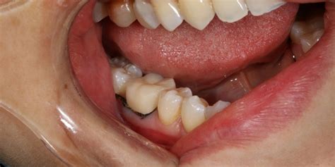 Болит зуб после чистки каналов