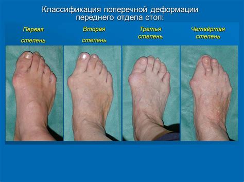Болит косточка на ноге около большого пальца лечение