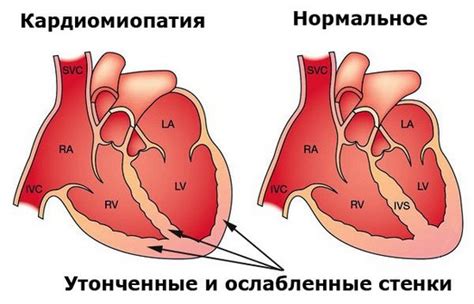 Вторичная кардиомиопатия