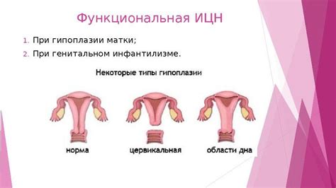 Гипоплазия матки 1 степени