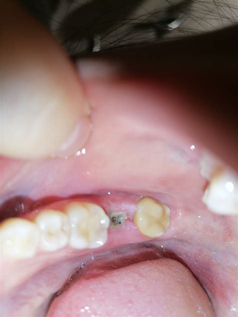 Губка после удаления зуба