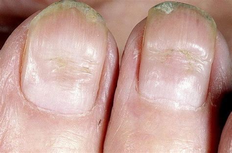 Заболевание ногтей
