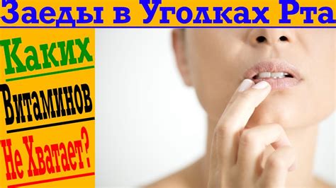 Заеды в уголках рта каких витаминов не хватает в организме