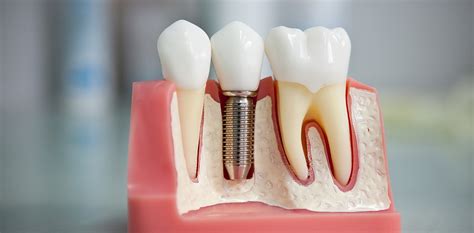 Имплантация зубов в челябинске цены
