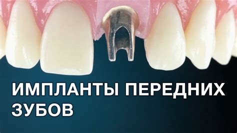 Имплантация зубов в челябинске цены