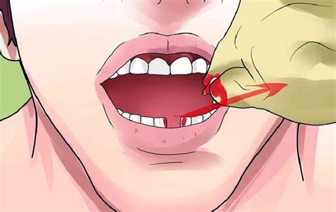Как вырвать зуб не больно