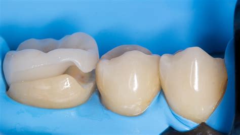 Керамическая накладка на зуб