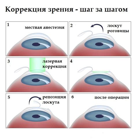 Лазерная коррекция зрения ульяновск