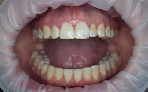 Меловидные пятна на зубах
