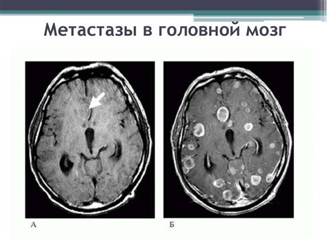 Метастазы в головном мозге продолжительность жизни без лечения