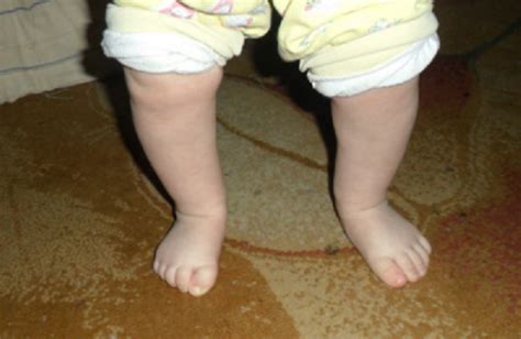 Ноги колесом у ребенка