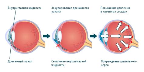 Нормальное глазное давление