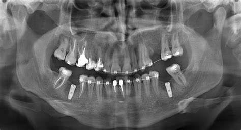 Оптг в стоматологии