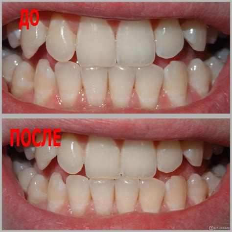 Отбелить зубы в домашних условиях без вреда для эмали