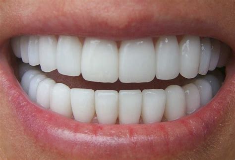 Отбелить зубы в домашних условиях без вреда для эмали