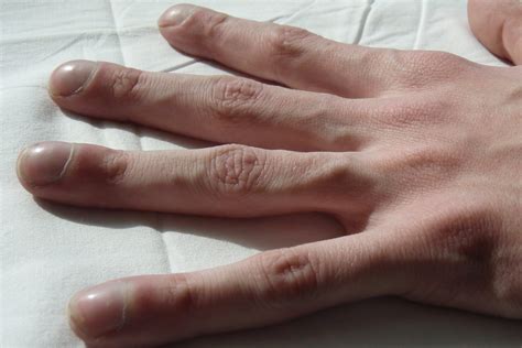 Пальцы барабанные палочки при каком заболевании