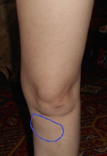 Почему болит кость на ноге ниже колена спереди