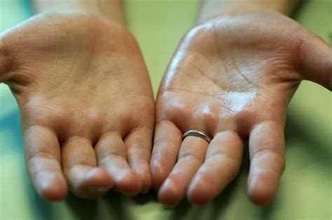 Почему потеют руки ладони