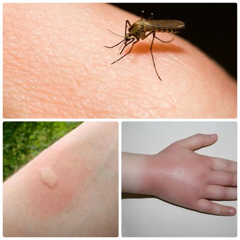 Почему чешутся укусы комаров