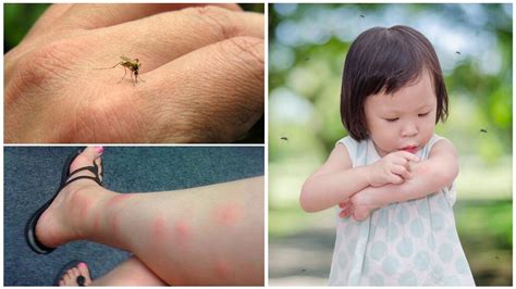 Почему чешутся укусы комаров