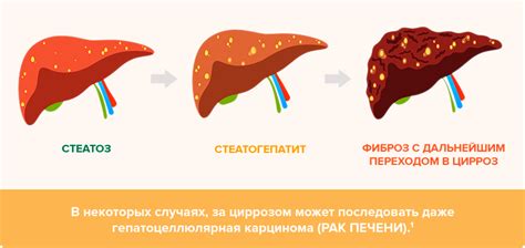 Признаки жирового гепатоза