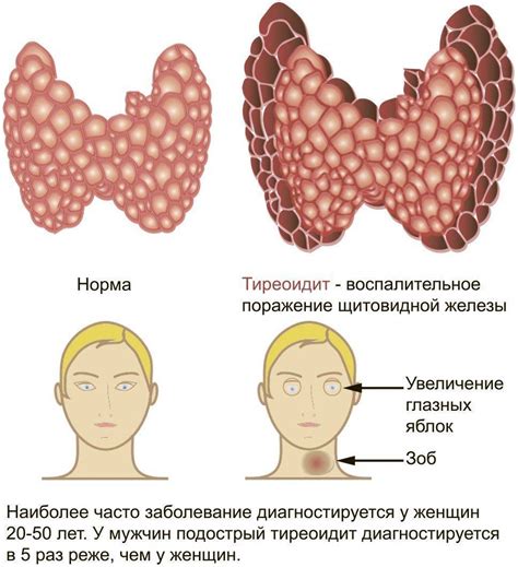Признаки щитовидной железы у женщин симптомы