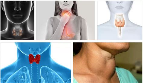 Признаки щитовидной железы у женщин симптомы