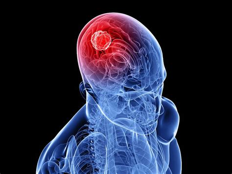 Рак головного мозга симптомы на ранних стадиях