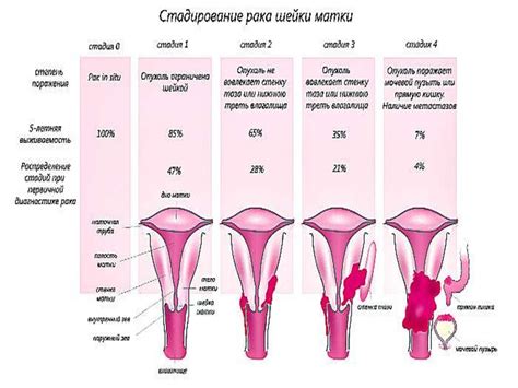 Рак шейки матки 1 стадия сколько живут