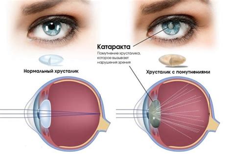 Реабилитация после замены хрусталика глаза при катаракте