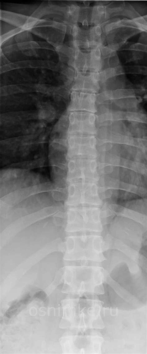 Рентгенография грудного отдела позвоночника