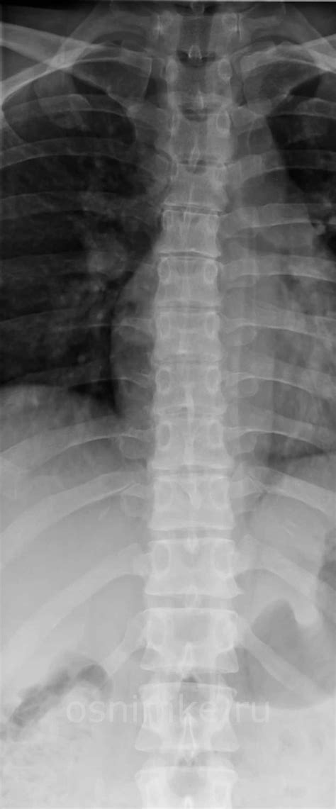 Рентгенография грудного отдела позвоночника