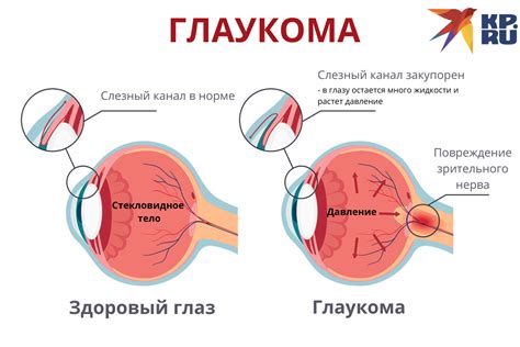 Симптомы глаукомы у взрослых