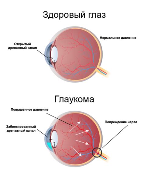 Симптомы глаукомы у взрослых