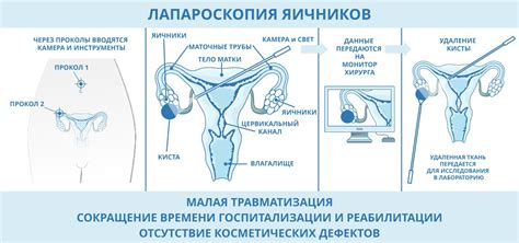 Симптомы кисты в яичниках у женщин