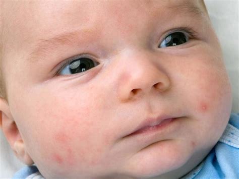 Сыпь на лице у новорожденного 1 месяц
