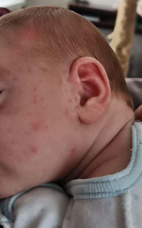Сыпь на лице у новорожденного 1 месяц