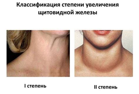 Увеличение щитовидной железы симптомы у женщин