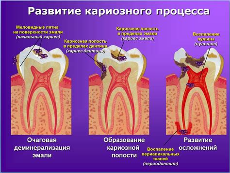 Удаление нерва в зубе