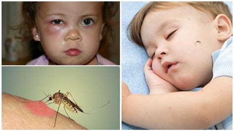 Что делать если укусил комар