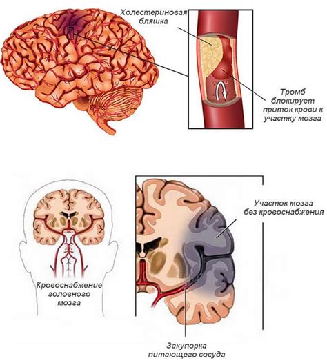 Что такое инфаркт мозга