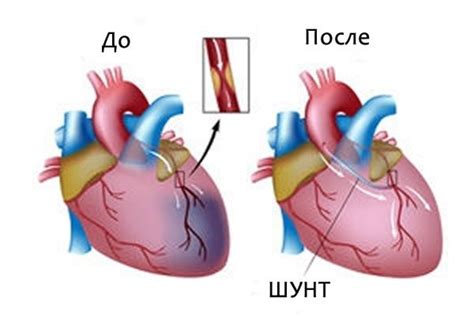 Что такое шунтирование сердца